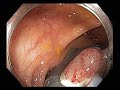 colonoscopy channel emr of a flat lesion