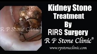 Kidney Stone Treatment by RIRS Surgery