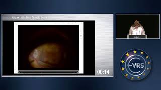 Myopic Schisis and Vitreomacular Traction