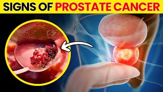 10 Signs and Symptoms Of Prostate Cancer. DON'T IGNORE!