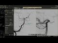 Case 5, Aneurysm of Basilar Artery 11-08-2024