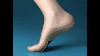 Custom made orthotics for plantar fasciitis