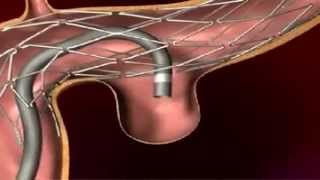 Endovascular Coiling for Brain Aneurysm