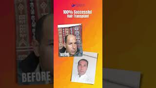 100% Successful Hair Transplant | Dr Kamal Ud Din | Cosmetico Clinic