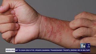 Las Vegas dermatologist's tips on how to combat dry, itchy skin during winter months