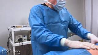 Creating Curves Using SmartLipo Triplex | Atlanta Liposuction Speciality Clinic