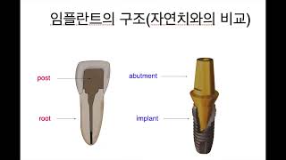 임플란트 파절(지대주편)