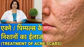एक्ने / पिम्पल्स के गड्ढों का ईलाज || Acne Scar Treatment