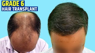 Dense Hair Transplant Result In Grade 6 Baldness | Best Hair Transplant Result In India |