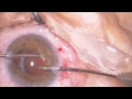 Iris suture of luxated IOL Lukan Mishev Live Stream