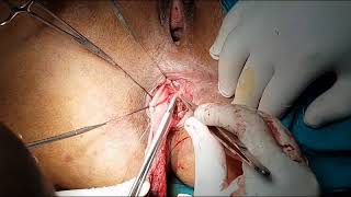Delorme Operation for Full-thickness Complete Rectal Prolapse