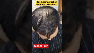 Leech therapy for hair growth Mumbai #kzhijama #shorts #reels #viral #leechtherapy #hairfall