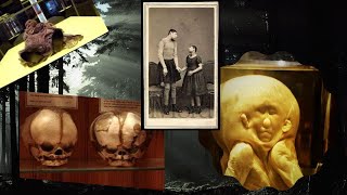 Human oddities  Medical Mystery unexplained , Mutter Museum