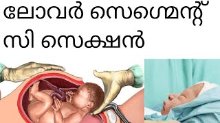 ലോവർ സെഗ്മെന്റ് സി സെക്ഷൻ | C-Section | @momandkids8888