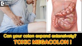 Toxic Megacolon: Signs, Symptoms & Treatment|Stomach Pain, Diarrhea-Dr. Ravindra BS| Doctors' Circle