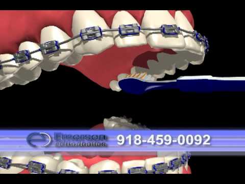 Keeping your teeth clean with Braces Keeping your teeth clean with Braces