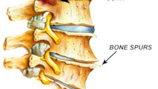 What does arthritis in the neck look like?