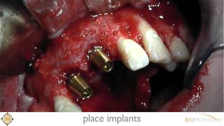 Anterior Dental Implants: Replacing Two Teeth with BioHorizons Tapered Internal Implants (2011)