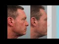 male blepharoplasty by dr. edwin williams