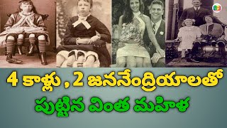 నాలుగు కాళ్లతో, రెండు గర్భాశయాల్లో ఐదుగురి పిల్లలకు జన్మనిచ్చిన వింత మహిళ || 4 legged Girl Story