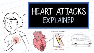 What is a Heart Attack? (HealthSketch)