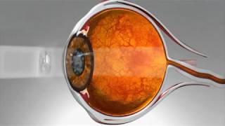 Cataract Options with Dr. Doe