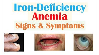 Iron-Deficiency Anemia Signs & Symptoms (ex. Fatigue, “Spoon Nails”, Cracked Lips)