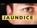 JAUNDICE | Types of Jaundice | Biochemical tests to investigate Jaundice || Cj Meds ||