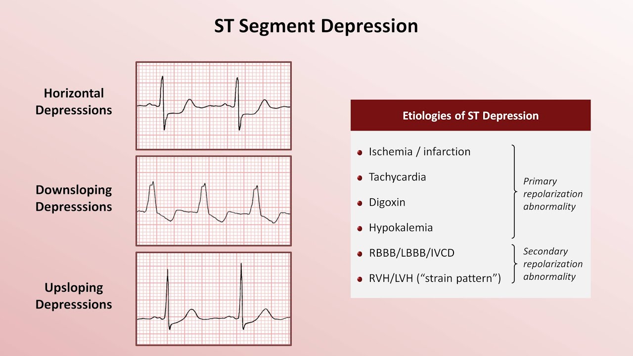 St Depression Vs St Elevation At Rebecca Skinner Blog