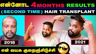 Hair transplantation result in 4 month | வழுக்கைத் தலையை நினைத்து இனி கவலை எதற்கு | chella ht