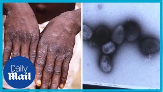 'Better late than never': Experts react to WHO monkeypox outbreak declaration