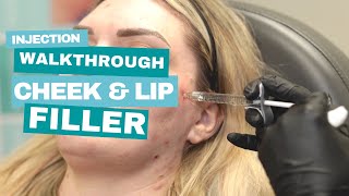 Juvederm | Cheek and Lip Filler