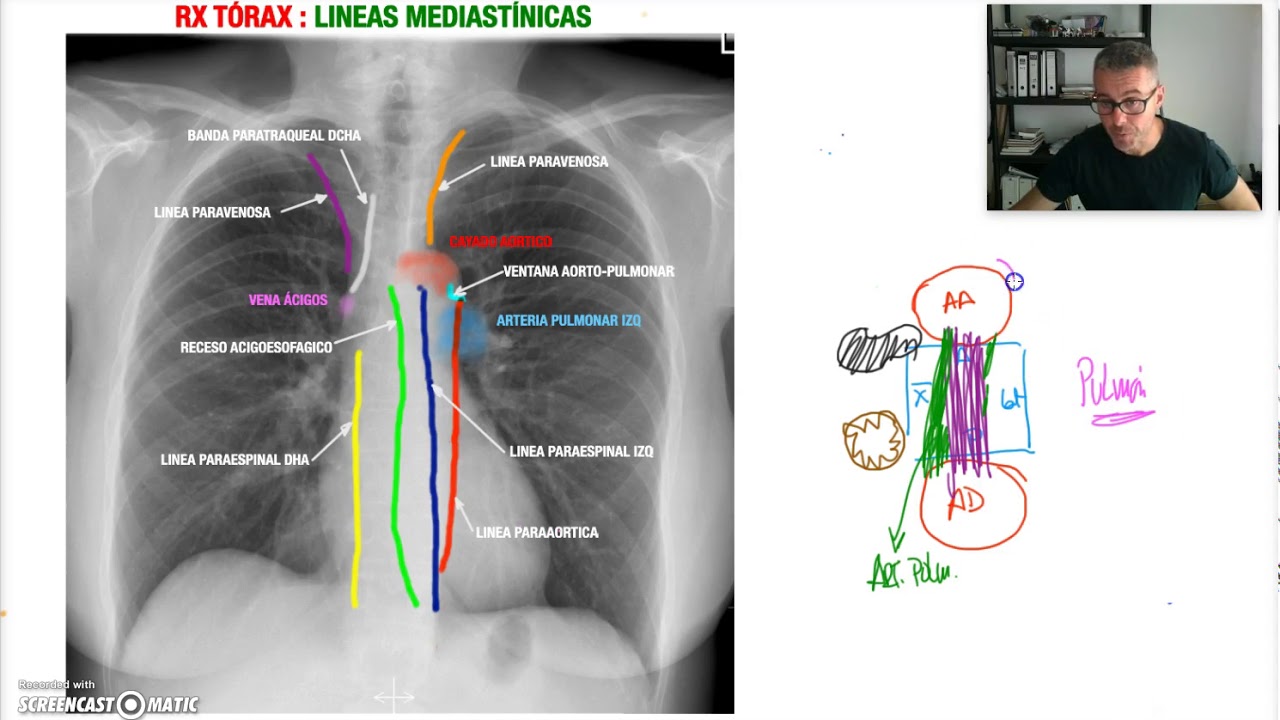 Rx Torax 6 PA (Lineas Mediastínicas) - YouTube