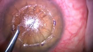 Gulani Academy Radial Keratotomy Corrective Series: Corneal Surgical Artistry; Corneoplastique!