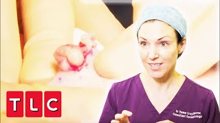 Dr Emma Pops Massive Cyst On Mans Forehead | Bad Skin Clinic