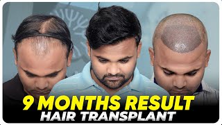 Hair Transplant in Kottayam | Best Results \u0026 Cost of Hair Transplant in Kottayam