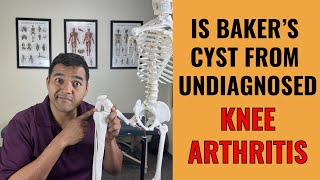 Why Undiagnosed Knee Arthritis Is To Blame For Your Painful Baker's Cyst