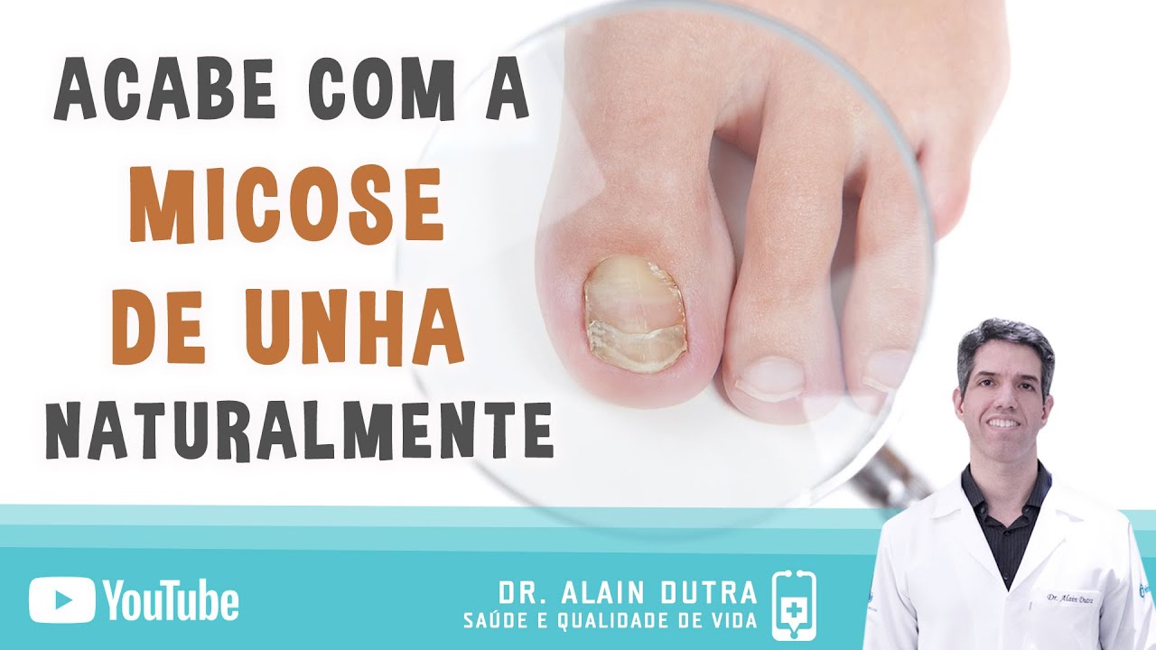 Micose De Unha - Tratamento Caseiro - Dr. Alain Dutra - YouTube