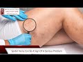 Spider Vein Removal New Haven CT by The Best Vascular Specialists