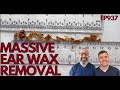 MASSIVE EAR WAX REMOVAL - EP937