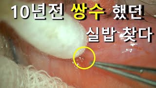 Suture Extrusion 10 Years after Asian Double Eyelid Surgery.