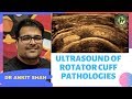 TMT: USG in Rotator Cuff Pathologies by Dr Ankit Shah