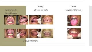 Challenges in treatment Oral Medicine Emergencies during the COVID-19 Pandemic : Case Report