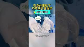 在体内放置了13年的乳房假体，你见过吗❓