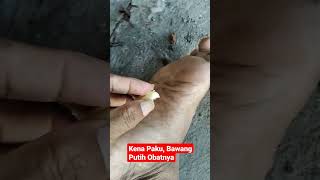 Kena Paku Bawang Putih Obatnya,#shorts