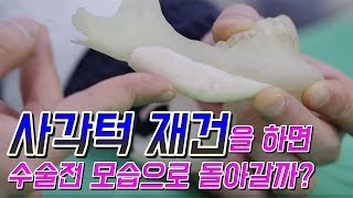 사각턱수술 부작용, 재건시 수술전 모습으로 돌아갈수 있을까?  [에이치성형외과]