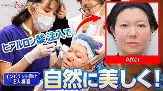 50代女性へのヒアルロン酸注射！自然な仕上がに大満足！