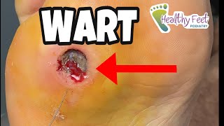 THE MOTHER WART | WART REMOVAL OF AN ENORMOUS PLANTAR WART!