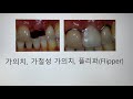 가의치 u0026 임시덴쳐 보철용어 풀이