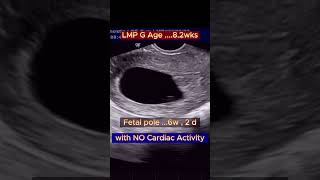 Early Pregnancy Miscarriage (Missed Abortion ) #ultrasound #pregnancy #miscarriage